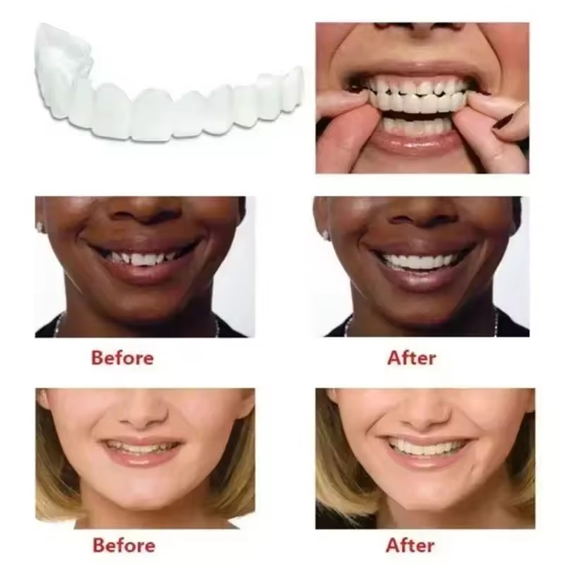 Teeth Veneers Whitening Dentur - Teeth Whitening Veneers ulasan dan harga