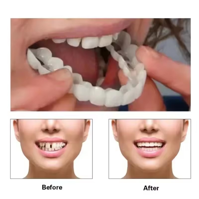 Teeth Veneers Whitening Dentur - Teeth Whitening Veneers ulasan dan harga