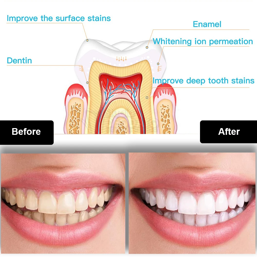 Dental Teeth Whitening Kit Min - Teeth Whitening Hydrogen Peroxide ulasan dan harga